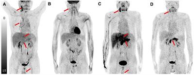 The different manifestations of 18F-FDG PET/CT and 68Ga-FAPI-04 PET/CT in evaluation of the steroid therapy response for IgG4-related disease: A case report